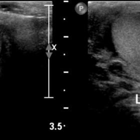 Scrotal ultrasound