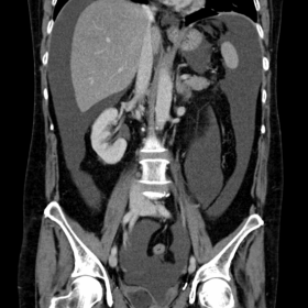 Initial contrast CT
