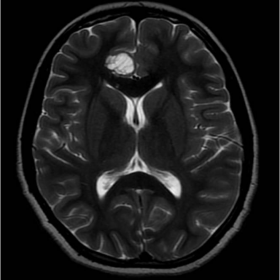 AXIAL T2W IMAGE