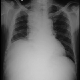 Frontal radiograph (19.07.2016) showing right paratracheal opacity