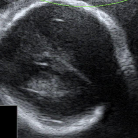 Anterior Coronal Ultra sonography(USG)