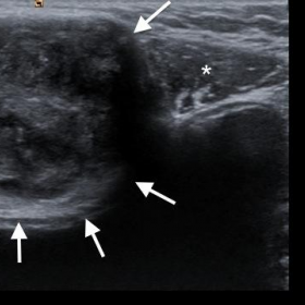 The sonography image of the mass