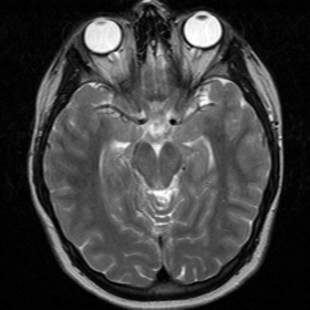 MRI T2 weighted images of the head