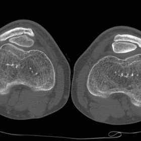 axial CT- bone window
