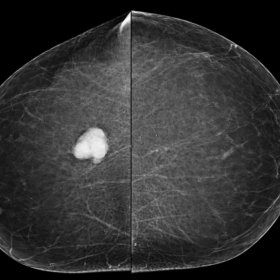 Cranio caudal mammography