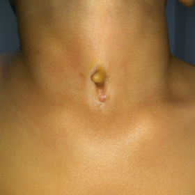 Midline cervical lesion