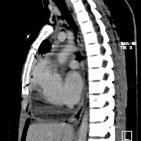 Enhanced CT, sagital view, mediastinal window