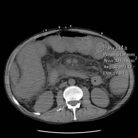 Unenhanced CT of the abdomen