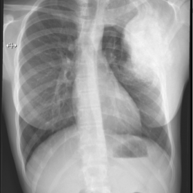 Chest conventional radiography
