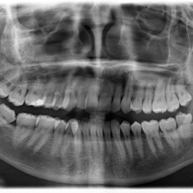 Dental Panoramic Radiograph