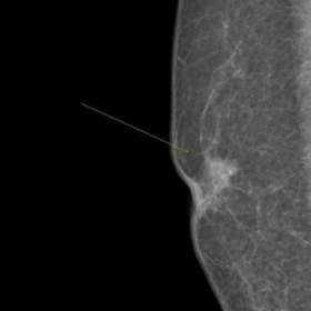 Mammography of the right breast, MLO view