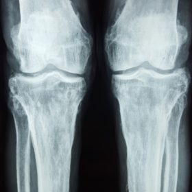AP radiograph of both knee joints