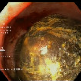 Endoscopic view of the obstructing gallstone.