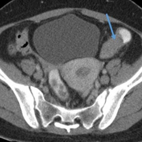Axial pelvic section of IV contrast-enhanced CT