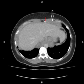 Axial post-contrast portovenous abdominal CT