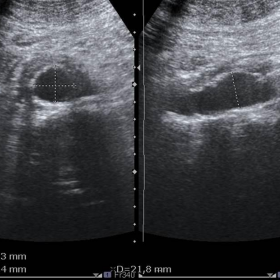 Abdominal ultrasound at level of mid aorta