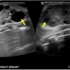 Ultrasound of both breast of neonate