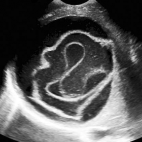Ultrasound image of hydatid cyst