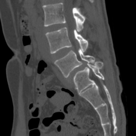 CT sagittal view lumbosacral spine