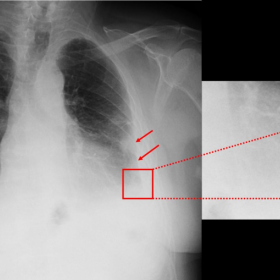 Initial chest X-ray