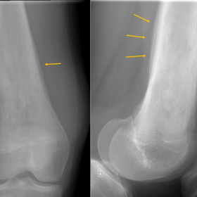 Anteroposterior and lateral radiographs of the right femur