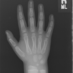 Right hand plain radiograph, at 6 years of age
