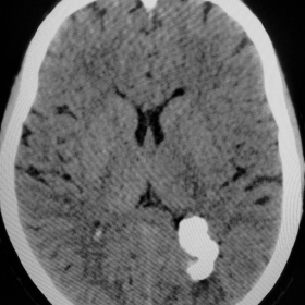 Noncontrast CT scan of brain