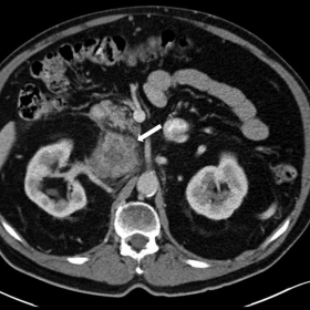 Abdominal CT with intravenous contrast