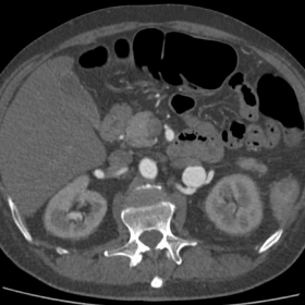 Contrast-enhanced abdominal CT scan in the arterial phase