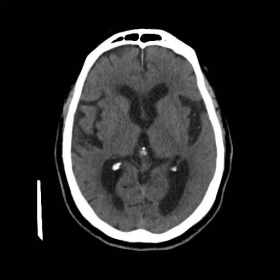 Cranial non-enhanced CT