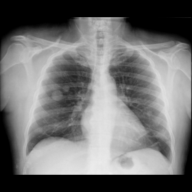 Chest X-ray (AP and lateral view)