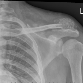 Left shoulder calcinosis