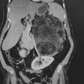 Inferomedial displacement of left kidney along with renal vein.