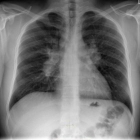 PA and lateral chest radiographs.