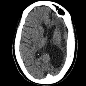 CT brain axial