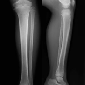 Left leg radiography