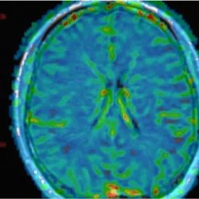 Color maps. DSC Perfusion MRI