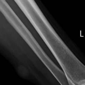 Plain X-ray of the left leg
