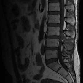 Sagittal T1-w MRI