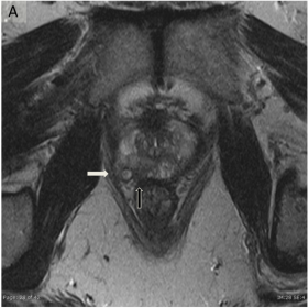MRI findings of prostate adenocarcinoma in NF1