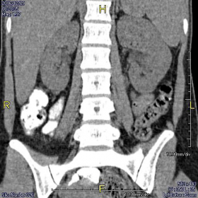 Left renal hypertrophied column of Bertin