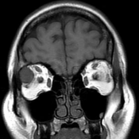 MRI coronal T1, T2 and T1 post-contrast images