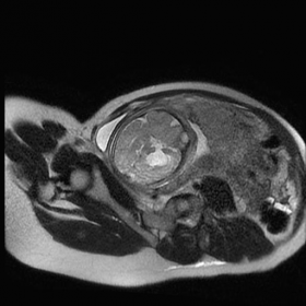 Fetal MRI. Oblique, coronal and sagittal.