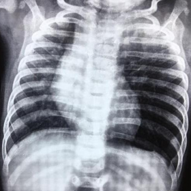 X-ray chest