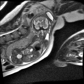 Fetal MRI images.
