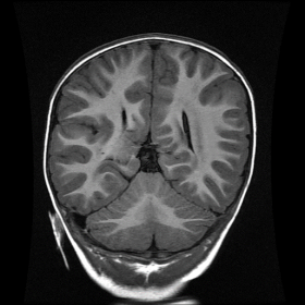 Brain MRI Coronal T1