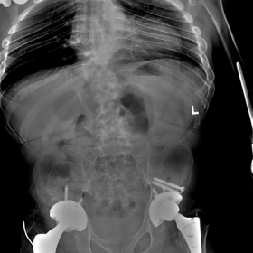 X-ray dorsal/lumbar spine