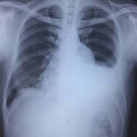 Chest Radiograph