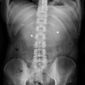 Plain abdominal radiographs