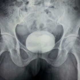 Plain X-ray pelvis AP view